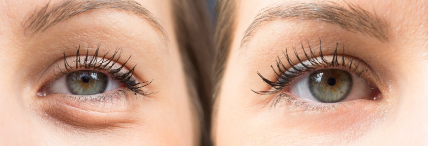 Under eye filler treatment is available in Dubai Under eye filler treatment is available in Dubai